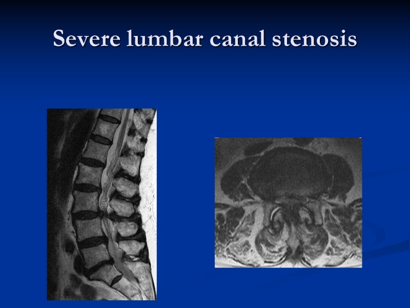 Severe lumbar canal stenosis